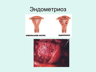 Эндометриоз
 