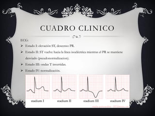 CUADRO CLINICO
ECG:
 Estado I: elevación ST, descenso PR.
 Estado II: ST vuelve hacia la línea isoeléctrica mientras el PR se mantiene
   desviado (pseudonormalizacion).
 Estado III: ondas T invertidas.
 Estado IV: normalización.
 