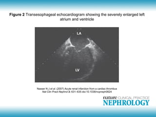 Figure 2 Transesophageal echocardiogram showing the severely enlarged left
                           atrium and ventricle




               Nasser N J et al. (2007) Acute renal infarction from a cardiac thrombus
                   Nat Clin Pract Nephrol 3: 631–635 doi:10.1038/ncpneph0624