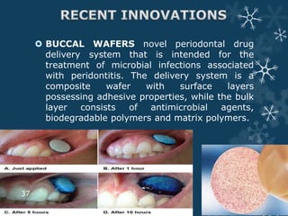 Buccal &Sublingual Drug Delivery System | PPTX