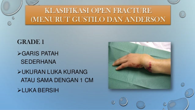 open vs closed fracture