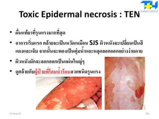 Toxic Epidermal necrosis : TEN
• ผื่นแพ้ยาที่รุนแรงมากที่สุด
• อาการเริ่มแรก คล้ายจะเป็นหวัดเหมือน SJS ผิวหนังจะเปลี่ยนเป็นสี
แดงและเจ็บ จากนั้นจะพองเป็นตุ่มน้าและหลุดลอกออกอย่างง่ายดาย
• ผิวหนังมักจะลอกออกเป็นแผ่นใหญ่ๆ
• ดูคล้ายกับผู้ป่ วยที่โดนน้าร้อนลวกชนิดรุนแรง
15-Aug-14 101
 