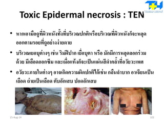 Toxic Epidermal necrosis : TEN
• หากเอามือถูที่ผิวหนังทั้งที่บริเวณปกติหรือบริเวณที่ผิวหนังก็จะหลุด
ออกตามรอยที่ถูอย่างง่ายดาย
• บริเวณเยอบุต่างๆ เช่น ริมฝีปาก เยื่อบุตา หรือ มักมีการหลุดลอกร่วม
ด้วย มีเลือดออกซึม และเมื่อแห้งก็จะเป็นแผ่นสีดาคล้าที่อวัยวะเพศ
• อวัยวะภายในต่างๆ อาจเกิดความผิดปกติได้เช่น กลืนลาบาก อาเจียนเป็น
เลือด ถ่ายเป็นเลือด ตับอักเสบ ปอดอักเสบ
15-Aug-14 102
 