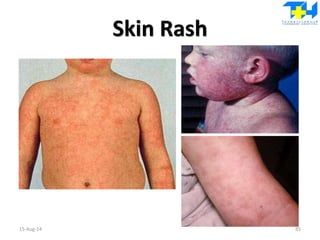 Skin Rash
15-Aug-14 85
 