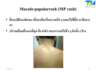 Maculo-papularrash (MP rash)
• ผื่นจะมีสีแดงชัดเจน เมื่อเอามือหรือกระจกใส ๆ กดลงไปที่ผื่น จะซีดจาง
ลง
• บริเวณที่พบผื่นมากที่สุด คือ ลาตัว และกระจายไปทั่ว ๆ กันทั้ง 2 ข้าง
15-Aug-14 87
 
