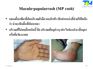 Maculo-papularrash (MP rash)
• แสดงผื่นแพ้ยาที่เกิดบริเวณฝ่ ามือและฝ่ าเท้า เป็นตาแหน่งที่ช่วยให้คิดถึง
ว่า น่าจะเป็นผื่นที่เกิดจากยา
• บริเวณที่ไม่พบผื่นชนิดนี้คือ บริเวณเยื่อบุต่างๆ เช่น ในช่องปาก เยื่อบุตา
หรือที่อวัยวะเพศ
15-Aug-14 88
 