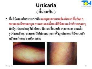 Urticaria
( ผื่นลมพิษ )
• ผื่นที่มีอาการในระยะแรกเป็นรอยนูนแดงขนาดเล็ก คันมาก ผื่นค่อย ๆ
ขยายออก มีขอบยกนูน ตรงกลางของผื่นจะมีสีซีดจางกว่าบริเวณรอบๆ
มักมีรูปร่างแปลกๆ ไม่แน่นอน มีการเปลี่ยนแปลงตลอดเวลา บางครั้ง
รูปร่างเหมือนวงกลม แต่มักไม่ครบวง บางครั้งดูคล้ายแผนที่มีขอบหยัก
หยักมา ผื่นกระจายทั่วร่างกาย
15-Aug-14 89
 