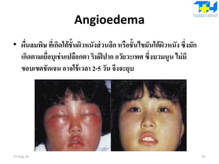 Angioedema
• ผื่นลมพิษ ที่เกิดใต้ชั้นผิวหนังส่วนลึก หรือชั้นไขมันใต้ผิวหนัง ซึ่งมัก
เกิดตามเยื่อบุเช่นเปลือกตา ริมฝีปาก อวัยวะเพศ ซึ่งบวมนูน ไม่มี
ขอบเขตชัดเจน อาจใช้เวลา 2-5 วัน จึงจะยุบ
15-Aug-14 91
 