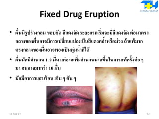 Fixed Drug Eruption
• ผื่นมีรูปร่างกลม ขอบชัด สีแดงจัด ระยะแรกเริ่มจะมีสีแดงจัด ต่อมาตรง
กลางของผื่นอาจมีการเปลี่ยนแปลงเป็นสีแดงคล้าหรือม่วง ถ้าแพ้มาก
ตรงกลางของผื่นอาจพองเป็นตุ่มน้าก็ได้
• ผื่นมักมีจานวน 1-2 ผื่น แต่อาจเพิ่มจานวนมากขึ้นในการแพ้ครั้งต่อๆ
มา จนอาจมากว่า 10 ผื่น
• มักมีอาการแสบร้อน เจ็บ ๆ คัน ๆ
15-Aug-14 92
 