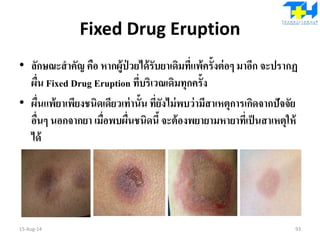 Fixed Drug Eruption
• ลักษณะสาคัญ คือ หากผู้ป่ วยได้รับยาเดิมที่แพ้ครั้งต่อๆ มาอีก จะปรากฏ
ผื่น Fixed Drug Eruption ที่บริเวณเดิมทุกครั้ง
• ผื่นแพ้ยาเพียงชนิดเดียวเท่านั้น ที่ยังไม่พบว่ามีสาเหตุการเกิดจากปัจจัย
อื่นๆ นอกจากยา เมื่อพบผื่นชนิดนี้ จะต้องพยายามหายาที่เป็นสาเหตุให้
ได้
15-Aug-14 93
 