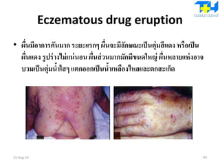 Eczematous drug eruption
• ผื่นมีอาการคันมาก ระยะแรกๆ ผื่นจะมีลักษณะเป็นตุ่มสีแดง หรือเป็น
ผื่นแดง รูปร่างไม่แน่นอน ผื่นส่วนมากมักมีขนดใหญ่ ผื่นหลายแห่งอาจ
บวมเป็นตุ่มน้าใสๆ แตกออกเป็นน้าเหลืองไหลและตกสะเก็ด
15-Aug-14 94
 