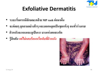 Exfoliative Dermatitis
• ระยะเริ่มแรกมีลักษณะคล้าย MP rash ต่อมาผื่น
• จะค่อยๆ ลุกลามอย่างช้าๆ และลอกหลุดเป็นขุยแห้งๆ จนทั่วร่างกาย
• ผิวหนังจะแดงและดูเป็นเงา บางแห่งตกสะเก็ด
• รู้สึกคัน แต่ไม่แสบร้อนหรือเจ็บที่ผิวหนัง
15-Aug-14 96
 