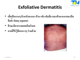 Exfoliative Dermatitis
• เมื่อเป็นนานๆ ผิวหนังจะหนา ด้าน แข็ง เล็บมือ และเท้าจะหนาและเป็น
สีคล้า ค่อยๆ หลุดออก
• ศีรษะมีอาการลอกคล้ายรังแค
• อาจมีไข้ รู้สึกหนาวๆ ร่วมด้วย
15-Aug-14 97
 