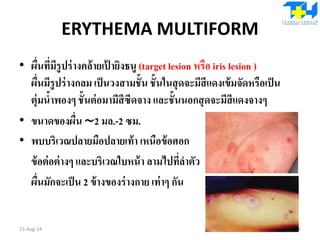 ERYTHEMA MULTIFORM
• ผื่นที่มีรูปร่างคล้ายเป้ ายิงธนู (target lesion หรือ iris lesion )
ผื่นมีรูปร่างกลม เป็นวงสามชั้น ชั้นในสุดจะมีสีแดงเข้มจัดหรือเป็น
ตุ่มน้าพองๆ ชั้นต่อมามีสีซีดจาง และชั้นนอกสุดจะมีสีแดงจางๆ
• ขนาดของผื่น ∼2 มล.-2 ซม.
• พบบริเวณปลายมือปลายเท้า เหนือข้อศอก
ข้อต่อต่างๆ และบริเวณใบหน้า ลามไปที่ลาตัว
ผื่นมักจะเป็น 2 ข้างของร่างกาย เท่าๆ กัน
15-Aug-14 98
 