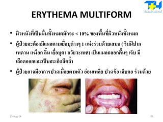 ERYTHEMA MULTIFORM
• ผิวหนังที่เป็นผื่นทั้งหมดมักจะ < 10% ของพื้นที่ผิวหนังทั้งหมด
• ผู้ป่ วยจะต้องมีแผลตามเยื่อบุต่างๆ 1 แห่งร่วมด้วยเสมอ ( ริมฝีปาก
เพดาน เหงือก ลิ้น เยื่อบุตา อวัยวะเพศ) เป็นแผลถลอกตื้นๆ เจ็บ มี
เลือดออกและเป็นสะเก็ดสีคล้า
• ผู้ป่ วยอาจมีอาการปวดเมื่อยตามตัวอ่อนเพลีย ปวดข้อ เจ็บคอ ร่วมด้วย
15-Aug-14 99
 