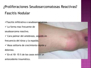 ¿Proliferaciones Seudosarcomatosas Reactivas? 
Fascitis Nodular 
Fascitis infiltrativa o seudosarcomatosa. 
 La forma mas frecuente de 
seudosarcoma reactivo. 
 Cara palmar del antebrazo, seguido en 
frecuencia del tórax y la espalda. 
 Masa solitaria de crecimiento rápido y 
doloroso. 
 En el 10- 15 % de los casos existe un 
antecedente traumático. 
 