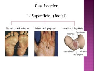 Clasificación 
1- Superficial (facial) 
Plantar o Ledderhorse Palmar o Dupuytren Peneana o Peyronie 
 
