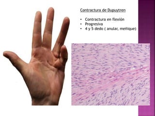 Contractura de Dupuytren 
• Contractura en flexión 
• Progresiva 
• 4 y 5 dedo ( anular, meñique) 
 