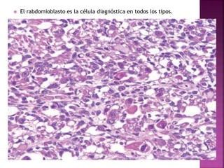  El rabdomioblasto es la célula diagnóstica en todos los tipos. 
 