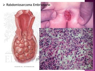  Rabdomiosarcoma Embrionario 
 