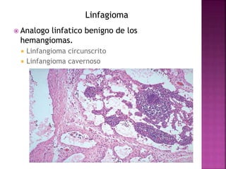 Linfagioma 
 Analogo linfatico benigno de los 
hemangiomas. 
 Linfangioma circunscrito 
 Linfangioma cavernoso 
 