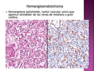 Hemangioendotelioma 
 Hemangioma epitelioide, tumor vascular unico que 
aparece alrededor de las venas de mediano y gran 
calibre. 
 