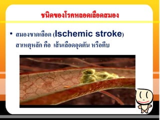 • สมองขาดเลือด (Ischemic stroke)
สาเหตุหลัก คือ เส้นเลือดอุดตัน หรือตีบ
 