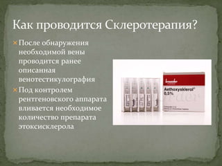 После обнаружения
необходимой вены
проводится ранее
описанная
венотестикулография
Под контролем
рентгеновского аппарата
вливается необходимое
количество препарата
этоксисклерола
 