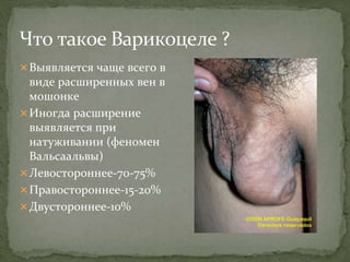 Выявляется чаще всего в
виде расширенных вен в
мошонке
Иногда расширение
выявляется при
натуживании (феномен
Вальсаальвы)
Левостороннее-70-75%
Правостороннее-15-20%
Двустороннее-10%
 