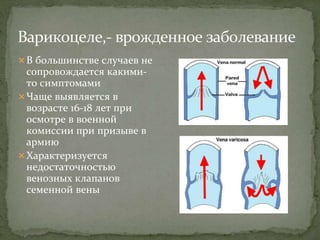 В большинстве случаев не
сопровождается какими-
то симптомами
Чаще выявляется в
возрасте 16-18 лет при
осмотре в военной
комиссии при призыве в
армию
Характеризуется
недостаточностью
венозных клапанов
семенной вены
 