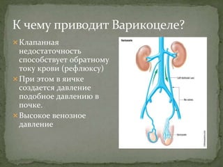 Клапанная
недостаточность
способствует обратному
току крови (рефлюксу)
При этом в яичке
создается давление
подобное давлению в
почке.
Высокое венозное
давление
 