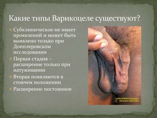  Субклиническое-не имеет
проявлений и может быть
выявлено только при
Допплеровском
исследовании
 Первая стадия –
расширение только при
натуживании
 Вторая появляются в
стоячем положении
 Расширение постоянное
 