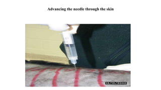Advancing the needle through the skin
 