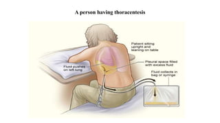 A person having thoracentesis
 