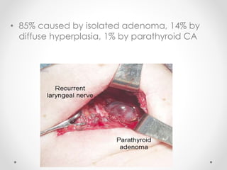 • 85% caused by isolated adenoma, 14% by
diffuse hyperplasia, 1% by parathyroid CA
 