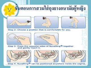 ขั้นตอนการสวมใส่ถุงยางอนามัยผู้หญิง
20/08/58 19
 