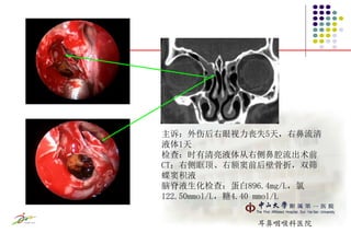 脑脊液鼻漏ppt 史剑波