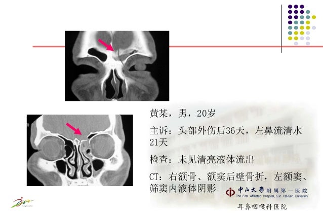 脑脊液鼻漏ppt 史剑波 脑脊液鼻漏ppt 史剑波