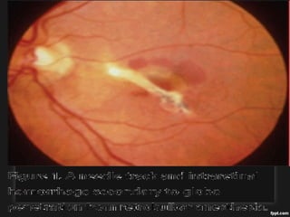 OCULOCARDIAC REFLEX
Bradycardia +/- Cardiac arrhythmia
Rx; ATROPINE (iv)
PERFORATION OF GLOBE
SUBCONJUCTIVAL HEMORRHAGE
DISLOCATION OF LENS
 