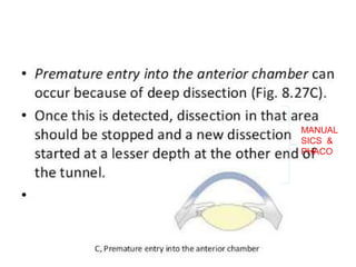 Incision related
Irregular incision- in ECCE
Button holing of anterior wall of tunnel
Premature entry into anterior chamber
Scleral disinsertion
MANUAL
SICS &
PHACO
 