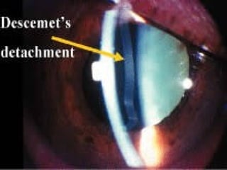 Corneal Injury
when A.C is entered with sharp
instruments
 