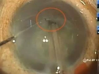 POSTERIOR CAPSULAR
RUPTURE
Feared complication in all Cataract
surgeries
Occurs due to-
forceful hydrodissection
direct injury by instruments
cortex aspiration (ACCIDENTAL PCR)
 