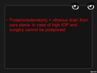 • Posteriorsclerotomy + vitreous drain from
pars plana- in case of high IOP and
surgery cannot be postponed
 