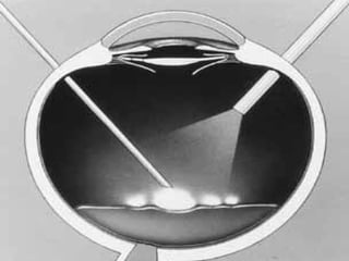 NUCLEUS DROP
mostly seen in PHACO
Rx- refer case to
VITRORETINAl surgeon
 