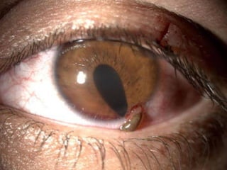 IRIS PROLAPSE
Common in ICCE and ECCE
 