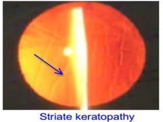 STRIATE KERATOPATHY
Due to endothelium damage (cornea)
corneal edema with descement folds
Rx: hypertonic saline drops + steroids
 