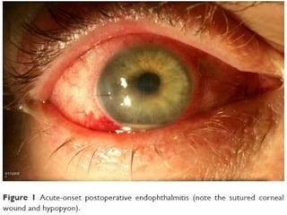 ENDOPTHALMITIS
Causes- instruments, solutions, surgeon hand,
patient own flora
ocular pain, conjuctival congestion, corneal
edema, exudates, diminished vision, hypopyon
Rx: IntraVitreal Antibiotics
steroids
supportive
vitrectomy
 