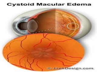 CME
Common in all cataract surgery but insignificant
develops 1-3 months later
EP: vitreous incarceration and iritis
Rx: anterior vitrectomy+steroids+anti-PGs
Prevention: preop and postop anti-PGs
 