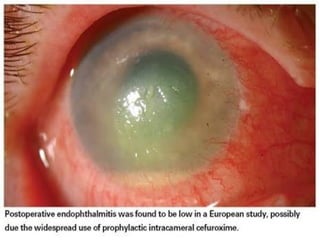 CHRONIC POSTOP
ENDOTHALMITIS
Agents
Rx: pars plana vitrectomy + Ab/Af therapy
 