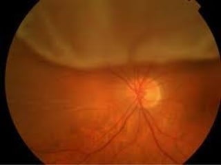RD
Aphakic>>>>phakic
ICCE >>> ECCE
R/F- vitreous loss, myopics
 